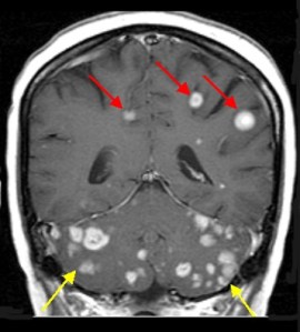 brain mets (for Jul-30 blog)